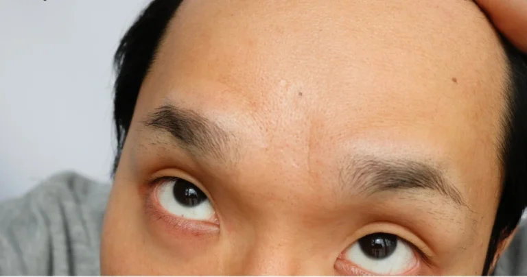 How Big Is a Big Forehead